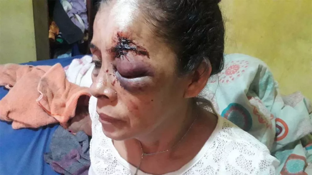 Mujer recibió un disparo en el ojo tras intervención policial en Garupá