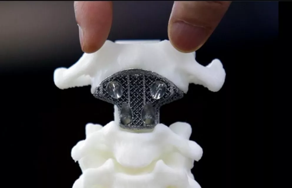 La vertebra hecha con la impresora 3D.