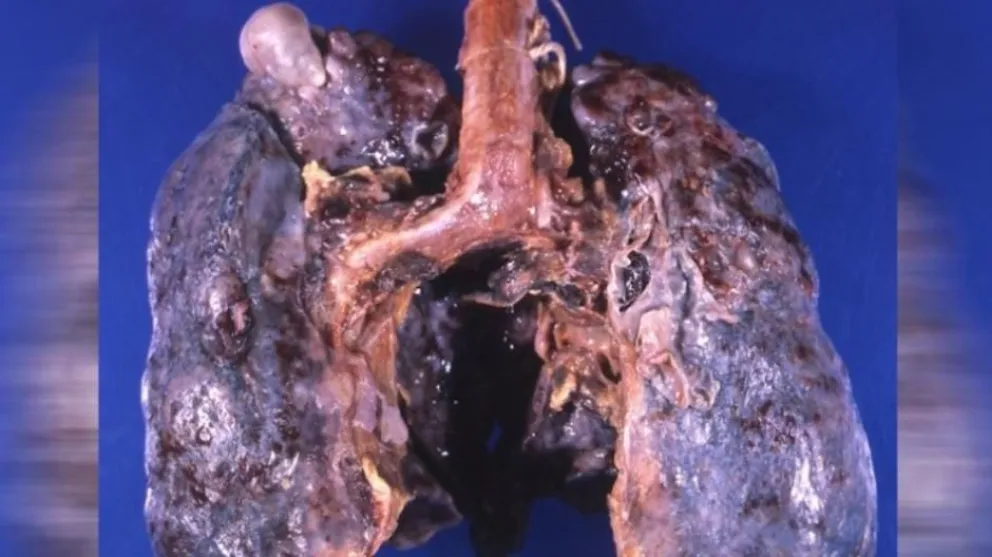 Un experimento muestra cómo queda el alquitrán en los pulmones