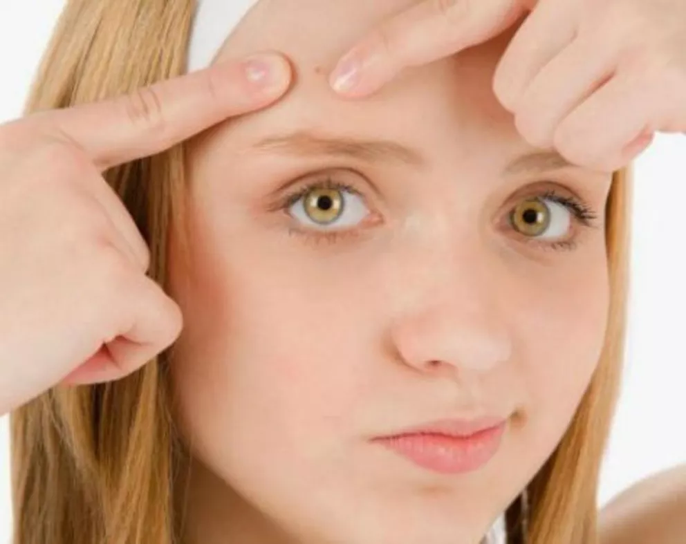 Atención chicos: médicos afirman que el acné tiene cura 
