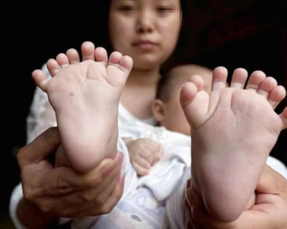 Un nene chino nació con 31 dedos entre pies y manos 