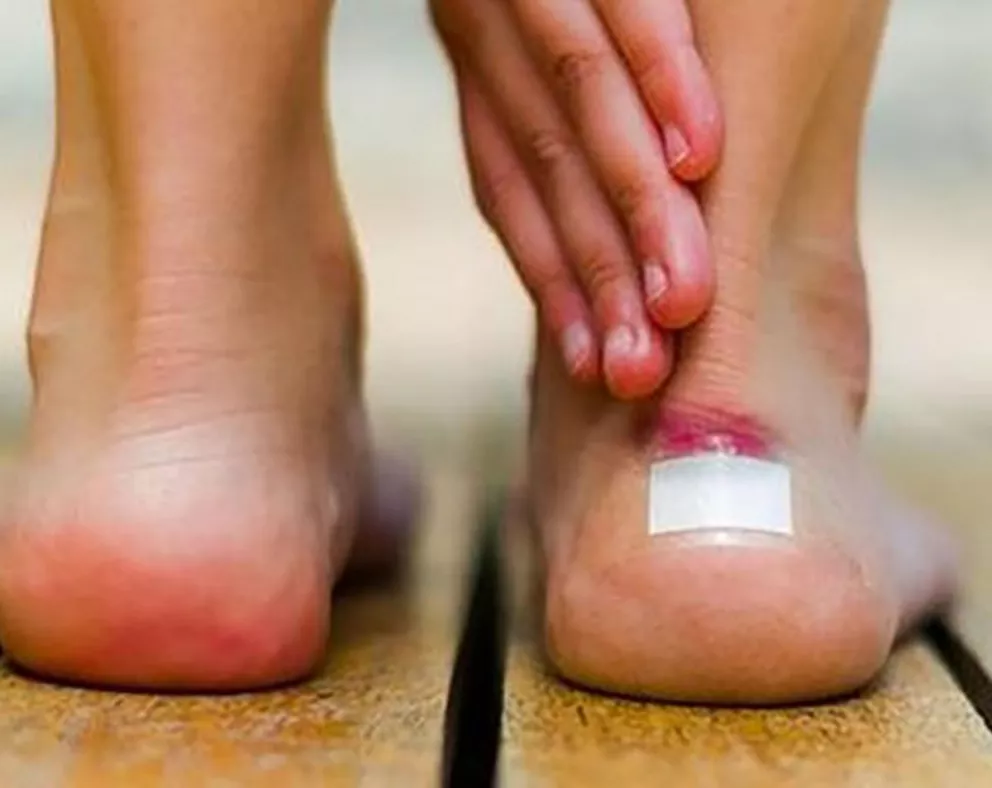 Diez trucos para evitar las rozaduras en los pies 