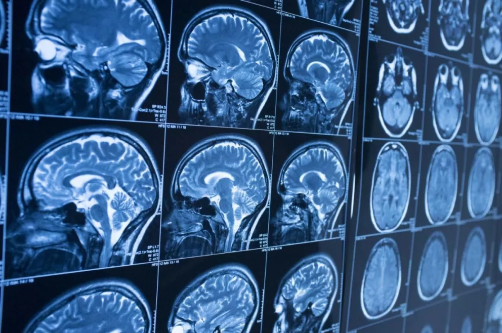 La inteligencia artificial es capaz de detectar Alzheimer diez años antes de los primeros síntomas
