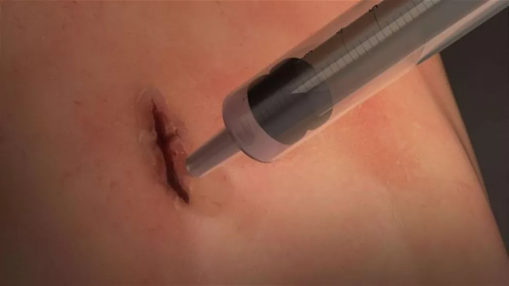 Adiós a los puntos: crean una goma que sustituiría a la sutura para cerrar heridas