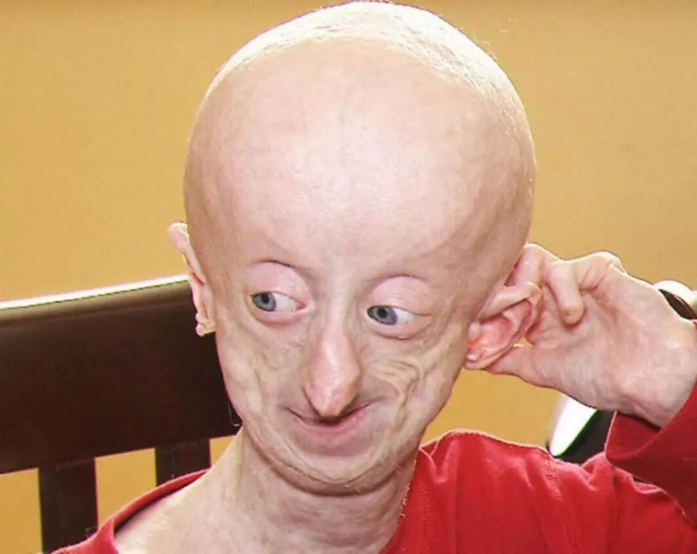 Progeria: la enfermedad que provoca que los niños luzcan como ancianos