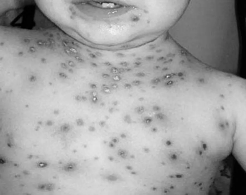 Hay niños internados con varicela en el pediátrico y aumentaron los casos