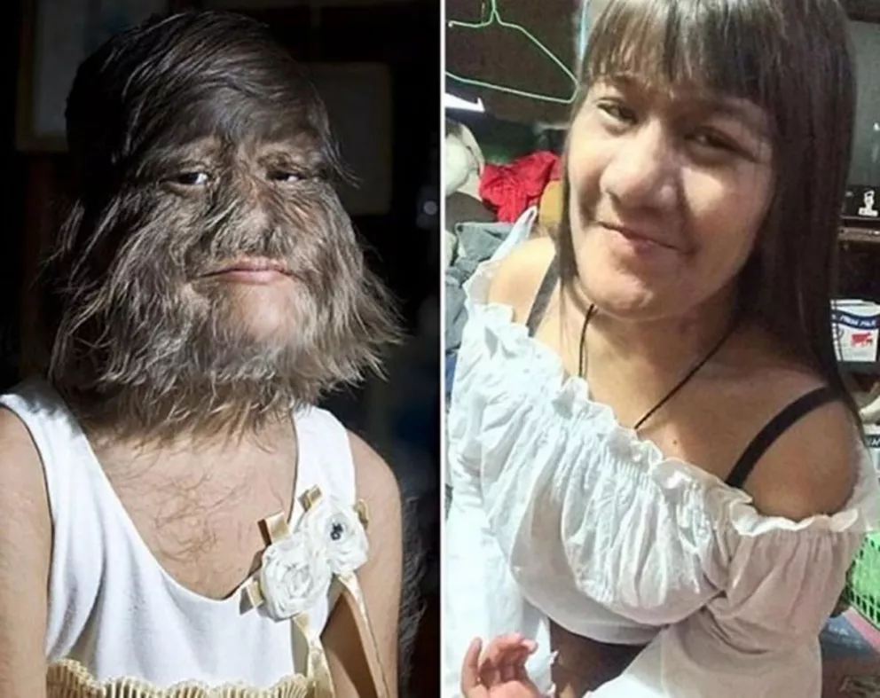  La mujer más peluda del mundo decidió afeitarse tras encontrar el amor 