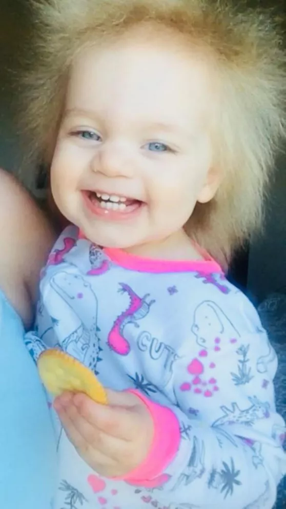 La bebé que tiene el síndrome del cabello impeinable y es furor en las redes