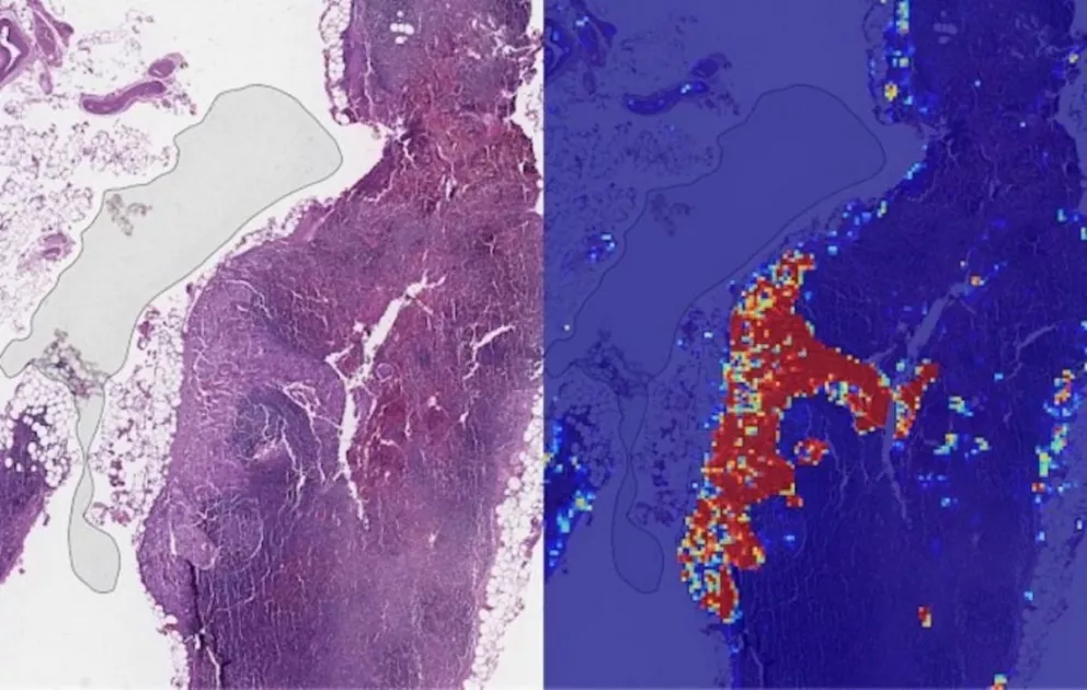 La IA de Google ya detecta cáncer de mamá avanzado con más precisión que los humanos