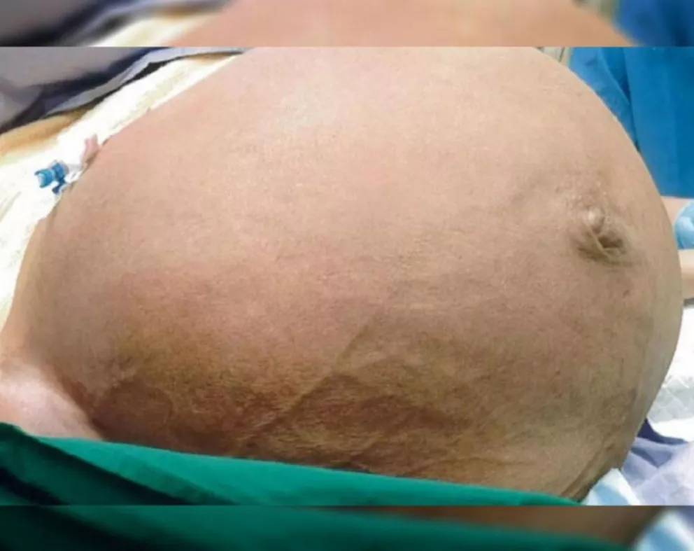 A una mujer le extirpan un tumor benigno de su útero del tamaño de una calabaza
