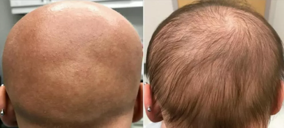 El efecto secundario de fármaco contra la dermatitis devuelve el pelo a una paciente calva 