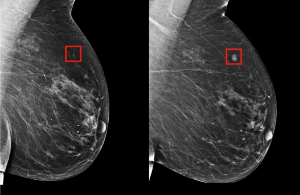Una IA detecta si una mujer desarrollará cáncer de mama en el futuro