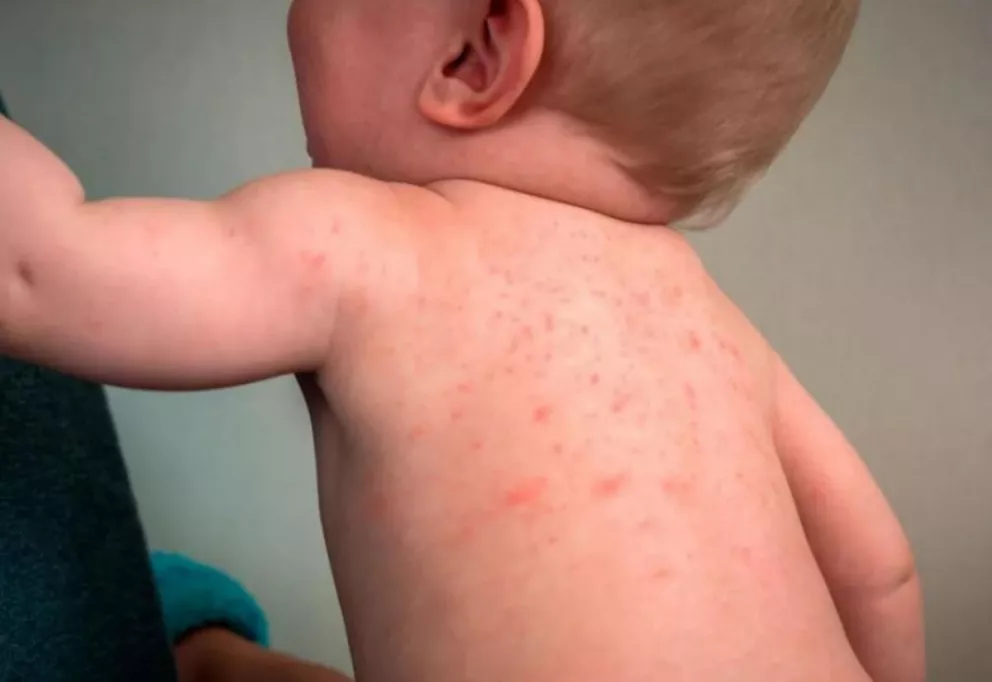 Confirman 8 nuevos casos de sarampión: 5 son hermanitos de una familia "antivacunas"
