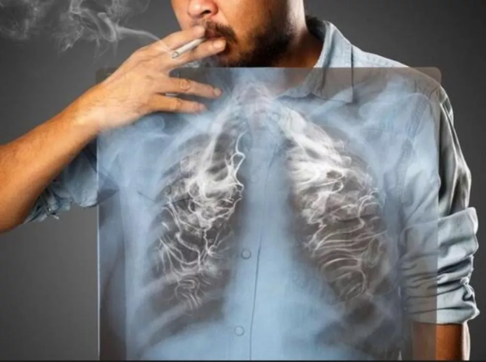 EPOC: la enfermedad en los pulmones que no tiene cura