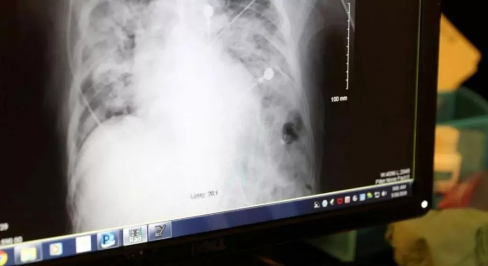  Italia: 3 de cada 10 recuperados quedarían con secuelas pulmonares