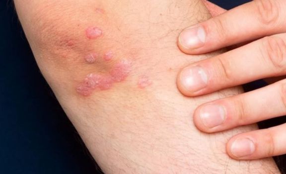 Madariaga: consultorio para la atención de la psoriasis atiende a 200 pacientes por año Madariaga: consultorio para la atención de la psoriasis atiende a 200 pacientes por año