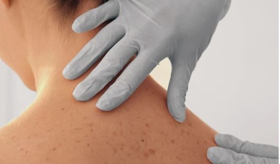 Cáncer de piel: Misiones, con múltiples factores de riesgo para contraer la enfermedad Cáncer de piel: Misiones, con múltiples factores de riesgo para contraer la enfermedad
